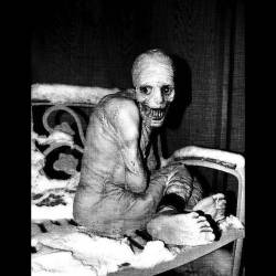 Lesch-Nyhan : Lesch-Nyhan Syndrome